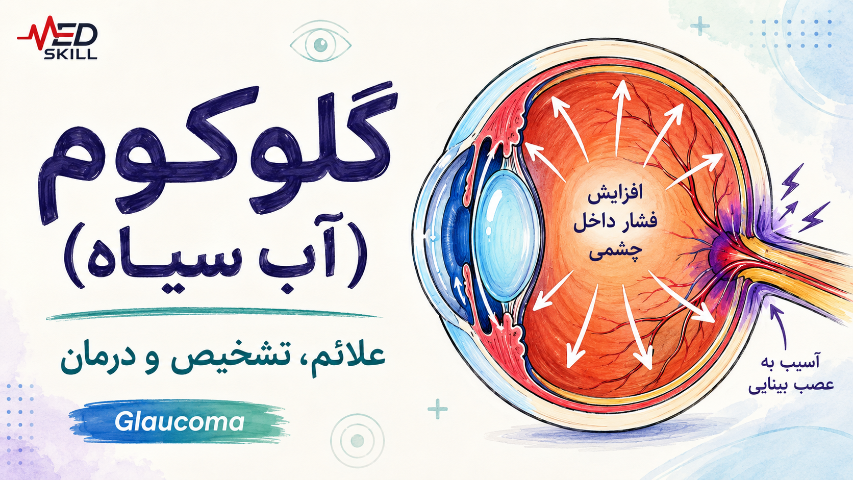 تصویر آموزشی گلوکوم یا آب سیاه ؛ علائم، تشخیص و درمان
